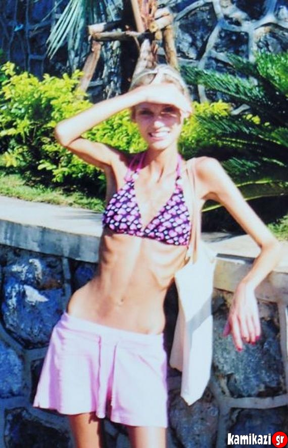 Recovery From Anorexia04
